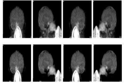 Maximum intensity projections from a brain scan of a healthy volunteer during O-15 inhalation, without (top row) and with (bottom row) out-of-FOV scatter correction.