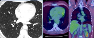 A 56-year-old man with a small nodule identified at low dose CT scan between the middle and right lower lobe. PET scan shows a high FDG uptake. A robotic segmental resection of the nodue was performed with a frozen section that showed a small cell lung cancer. Patient was treated with chemo and radiotherapy with success. Image courtesy of Dr. Giulia Veronesi.