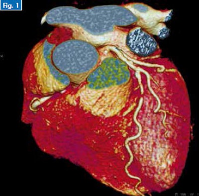 Figure 1. Cardiac CT scan for chest pain of an acute coronary syndrome type with a normal ECG and troponin levels shows tight stenosis of left anterior descending (LAD) II.