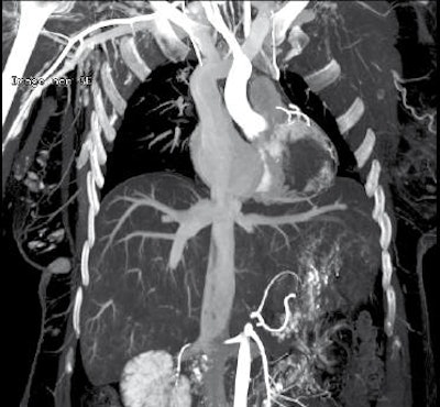 Maximum intensity projection (MIP) late reconstruction of a postmortem angiography scan (third injection with body in dorsal decubitus).