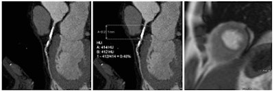 Coronary artery stenosis without hemodynamic significance: CCTA images are at left and center, while MRI (the reference standard for myocardial ischemia) is on the right. Images courtesy of Dr. Rozemarijn Vliegenthart.