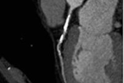 2014 11 04 10 13 50 498 2014 11 Den Dekker Cco Stenosis 20141104171605