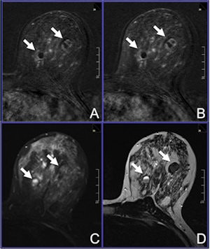 2014 11 04 17 43 32 222 2014 11 05 Breast Mri Figure 1 300