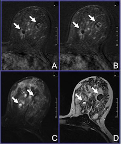 2014 11 04 17 43 32 222 2014 11 05 Breast Mri Figure 1 300