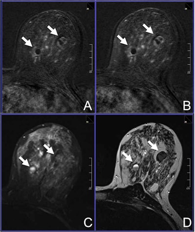2014 11 04 17 43 32 779 2014 11 05 Breast Mri Figure 1 800