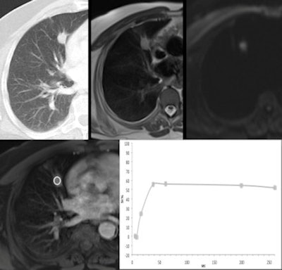 A 63-year-old man smoker, with a < 3.0 cm indeterminate nodule in the middle lobe. CT image (lung window), T2-weighted morphological MR image, diffusion-weighted imaging (DWI) (b = 800) and one contrast-enhanced VIBE image. The morphological MR images can easily depict the nodule's shape and contours, as is demonstrated on CT. This nodule showed higher restriction signal on DWI and a prominent and fast enhancement on dynamic postcontrast images, with an early peak of enhancement > 15% and maximum enhancement > 40%, suggesting malignancy. It was a pulmonary squamous cell carcinoma. Image courtesy of Dr. Marcel Koenigkam Santos, PhD.
