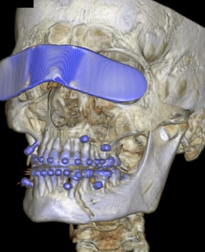 The 3D CT reconstruction shows a mandibular fracture, which was fixed surgically by wiring. To protect the eyes from x-rays, a Bismuth protector was placed in front of the eyes. Image courtesy of Dr. Florian Dammann.