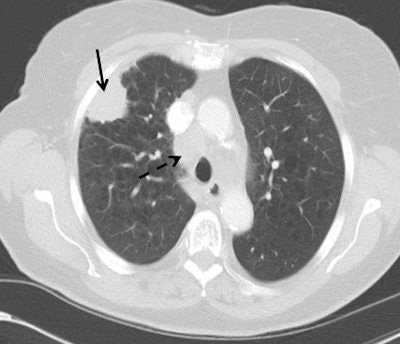Stage IIIa lung cancer