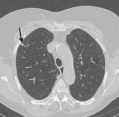 Top: Early stage lung cancer detected by CT. The 10-year survival rate is more than 90%. Bottom: A stage IIIa lung cancer where cure is unlikely. Solid line primary cancer can be seen, and the dotted line shows mediastinal nodes. All images courtesy of Dr. David Baldwin.