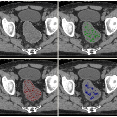 A standard CT scan (top left) with the tumor outlined in white. With the TexRAD software applied, it is possible to analyze the tumor's texture at a fine (red), medium (green), and coarse (blue) level. Image courtesy of bowel cancer case analysis from University College London Hospital.