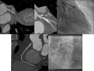Comparison images demonstrating how high-definition CT angiograpy improved reporting accuracy. The case is of a 49-year-old man with previous stent to the circumflex artery with recurrent pain. New scanner technology allows the use of CCTA in patients with known existing heart disease and gives the interventional cardiologist the required information to plan the subsequent intervention. Top left image shows a stent in the circumflex artery but no stenosis. Bottom left shows an occluded right coronary. Top middle also is of the circumflex but demonstrates how the use of the Discovery CT750 HD scanner (GE Healthcare) allows clear visualization of the short stenosis, despite the stent and high level of calcium in the arteries. Top right is a conventional left coronary angiogram confirming the CT findings. Bottom right is the right coronary angiogram confirming findings. All images courtesy of Dr. Carl Roobottom, Plymouth University Hospital, U.K.