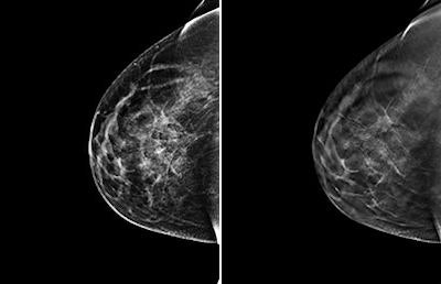 Left, 2D FFDM view of breast of 46-year-old woman. Right, 3D digital tomosynthesis view of breast. Images courtesy of Dr. Per Skaane, PhD.