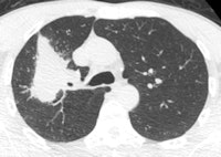 CT image