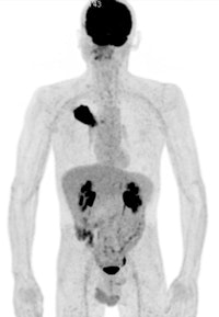 A 50-year old male patient with NSCLC stage pT2b pN2 cM0, imaged with FDG-PET/CT-MR. On coronal PET maximum intensity projection (MIP) image, an FDG-avid tumor in the right upper lobe and a mediastinal lymph node metastasis are seen. All images courtesy of Dr. Martin Huellner.
