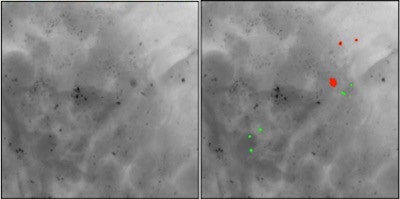 If confirmed, the new method would allow discrimination between type I (green) and type II (red) microcalcifications in a noninvasive way.