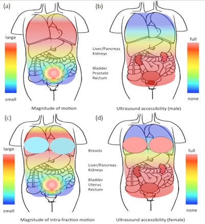 Schematic representation of the varying magnitude of tissue intrafraction motion (a) and (c) and the varying accessibility of tissue by ultrasound for the purpose of intrafraction motion tracking (b) and (d), in the male and female upper torso. Image courtesy of Emma Harris.