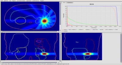 Kidney treatment plan created using the team's fast IMRT optimization system. Image courtesy of Bas Raaymakers.