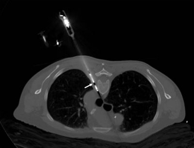 Treating pain by introducing a probe into the tumor under CT guidance. The tip of the probe (arrow) is heated to 100°C with the aid of microwave energy and leads to thermal ablation of the tumor tissue with immediate relief from pain.