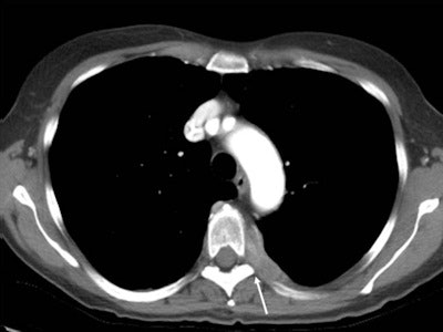 Pleural carcinosis in ovarian cancer with severe intercostal neuralgia due to tumor compression at the nerve exit point (arrow).