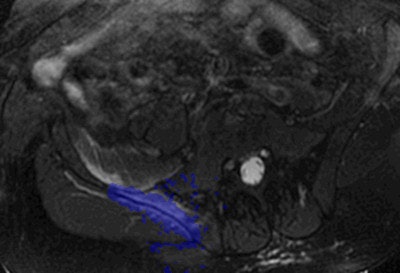 Noninvasive thermal ablation of a prostate cancer metastasis, using focused ultrasound, entirely without needles, catheter, or scalpel. The area highlighted in blue shows the heat distribution within the bone and tumor, which is measured with the aid of MRI during treatment and that ultimately displays the destruction of the metastasis.