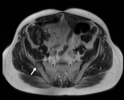 Painful osteoblastic prostate cancer metastasis in the right ilium (arrow). All images copyright of Dr. Markus Düx.