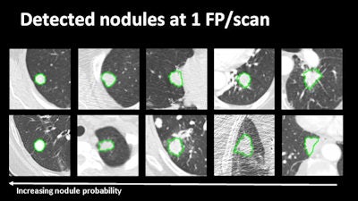 Examples of large-nodule detection at one false-positive per scan (above) as well as false-positives and missed lesions at various settings (below).