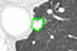 2015 01 16 12 36 26 747 2015 01 19 Lung Cad Van Ginniken Fps And Missedlesions 20150116194008
