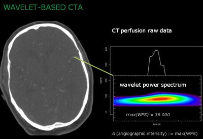 Wavelet transform applies the wavelet power spectrum to CT perfusion raw data to boost angiographic intensity.