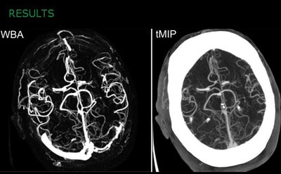 WBA method provides better contrast-to-noise ratio and is qualitatively superior to tMIP images. All images courtesy of Lukas Havla, PhD.