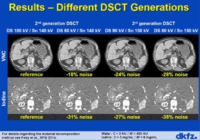 Third-generation DSCT showed low noise levels at virtual noncontrast (VNC) and iodine-enhanced images. All images courtesy of Dr. Marc Kachelreiss, PhD.
