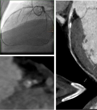 A 62-year-old smoker with hypertension, dyslipidemia, and diabetes had a 93% stenosis in the left anterior descending artery. The MLA was 1.4 mm2, the minimum lumen diameter was 1.1 mm, the area stenosis was 75%, and the diameter stenosis was 69%. The patient was revascularized. All images courtesy of Dr. Fabian Plank.