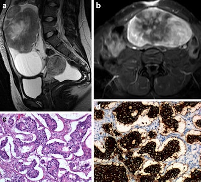 Metastatic ovarian carcinoid of unknown primary origin in a 23-year-old female complaining of pelvic pain and amenorrhoea. Sagittal T2-weighted MR image (a) and axial T1-weighted MR image with fat saturation, after intravenous gadolinium administration (b). Large, well-defined solid lesion of the left ovary, cranially and anteriorly located in relation to the uterus. On T2-weighted imaging, it displays intermediate signal intensity and shows a central high signal region. The lesion shows peripheral, intense, contrast enhancement, and a large central area of necrosis. Inferiorly to the solid tumor, a large simple cyst is found. A small amount of ascites is found in the cul-de-sac. H&E section of the ovary occupied by a tumor with insular pattern composed by neuroendocrine cells (c). These cells have intense cytoplasmatic staining for synaptophysin (d) and have small chromogranine-positive granules in the cytoplasm (not shown). Image courtesy of Dr. João Lopes Dias.