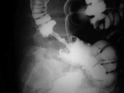 Double-contrast barium enema shows apple core lesion due to carcinoma of colon.