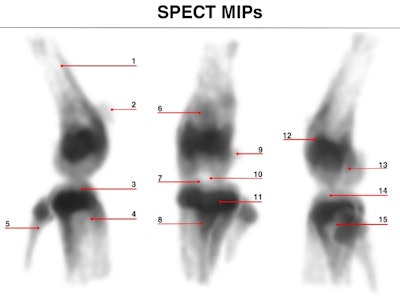 Maximum intensity projections of focused mouse knee joint SPECT (top) and corresponding micro-CT scan (bottom). The SPECT images provide an unprecedented level of uptake details in a mouse knee such as in structures like corpus femoris (labeled 1), patella (2), tibia, condylus medialis (3), corpus tibiae (4), corpus fibulae (5), basis patellae (6), linea epiphysialis (7), tuberositas tibiae (8), sesamoid bone (9), tuberculum intercondylare laterale (10), growth plate (11), epicondylus lateralis (12), fossa intercondylaris (13), tibia, condylus lateralis (14) and apex capitis fibulae (15). The CT scan below the SPECT images shows the corresponding structural details of the same mouse knee.