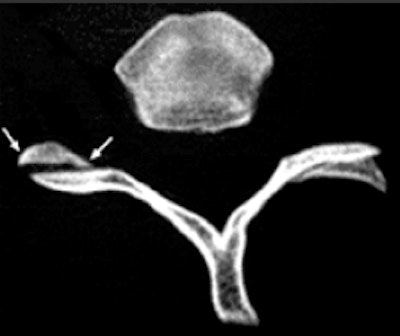 On CT, the vertebral facet joint space can look like a hamburger. All images courtesy of Fathima Hasan Mohamed.