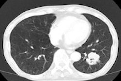 2014 08 11 15 04 51 8 2014 08 12 Ct Lung2 200