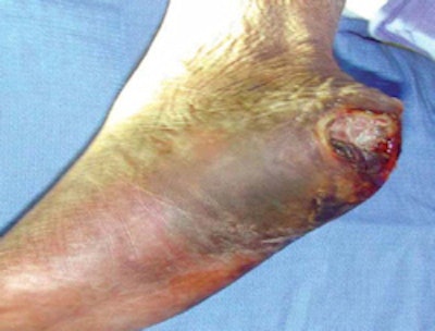 A 73-year-old woman presented with a heel ulcer