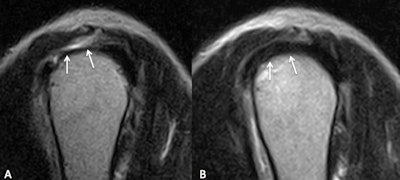 Sagittal T2-weighted MR images of the shoulder. Focal lesion (arrows) is shown on left (A). Image taken two years later (B) shows evidence of healthy rotator cuff tendon.