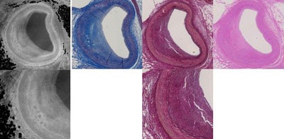 Figure demonstrates an early fibrous plaque. Top row: Phase contrast image; absorption image; histopathology including Masson's trichrome (dark blue), Elastic van Gieson (red image), Hematoxylin, and Eosin stainings (light blue). Bottom row: Zoomed in phase contrast image and zoomed in histopathologic image to demonstrate the good visibility of the three vessel layers in phase contrast imaging. All images courtesy of Dr. Sebastian Winklhofer.