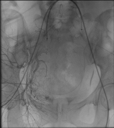 Top: Bilateral embolization of both uterine arteries. Bottom: Bilateral uterine arteries ballooning.