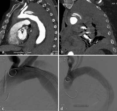 Ruptured type B dissection with stent graft implantation. An 83-year-old patient with ruptured type B dissection in parasagittal reformations demonstrating intimal tear (a) and hematothorax (a, b). Stent graft implantation (c) (partially covering the left subclavian artery) and exclusion of the dissection after expansion of the stent graft (d).