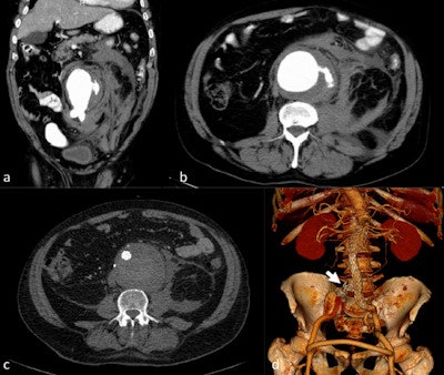Ruptured abdominal aortic aneurysm with stent graft treatment. The 72-year-old man presented with left-sided abdominal pain and hypotension. CTA demonstrated a ruptured infrarenal aortic aneurysm on coronal and axial sections (a-b). The patient was treated with aorto-uni-iliac stent graft implantation (d) to the left, a crossover bypass, and placement of an occluder (arrow) in the right common iliac artery. Follow-up CTA (c) demonstrated complete exclusion of the large aneurysm. All images courtesy of Dr. Esther Voitle, from Insights into Imaging.