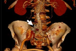 2015 02 12 11 50 40 579 2015 02 13 Aortic Emerg Thumb