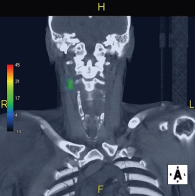 Image of a sentinel node in the neck after injection of Tc-99m tilmanocept. Image courtesy of Dr. Remco de Bree.