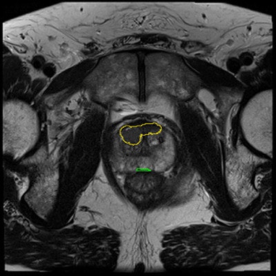 True-positive prostate