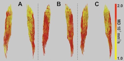 Image shows fiber tractography of the biceps femoris muscle at the three study time points for one marathoner. The fiber tracts are color-coded to show the changes in mean diffusivity. Image courtesy of Radiology.