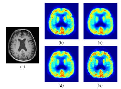 (a) T1-weighted MPRAGE MRI; PET images: (b) uncorrected; (c) Gaussian filtered; (d) MRI-guided filtered; (e) MRI-guided PVC.