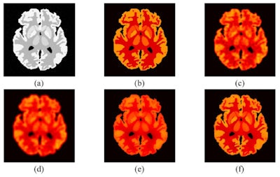 a) The MRI Zubal phantom with 5% Rician noise; (b) the true PET image at frame 11; (c) typical reconstructed image at frame 11 by FBP for one realization; (d) PET image filtered using Gaussian filtering; (e) PET image filtered by MRI-guided filtering; (f) PET image corrected by MRI-guided PVC.