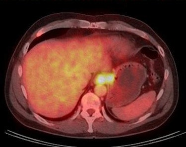 Images show carcinoma at the esophagogastric junction before therapy (pre therapy) and after two cycles of chemotherapy (post therapy). The image after two cycles of chemotherapy demonstrates complete metabolic response. Image courtesy of Dr. Gerald Antoch.