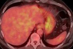 2015 02 26 13 13 14 983 2015 03 04 Ecr Today Antoch Esophageal Cancer Post Therapy 20150226201338